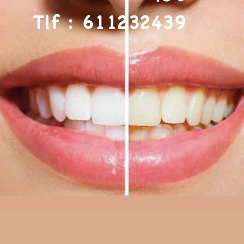 Blanqueamiento dental