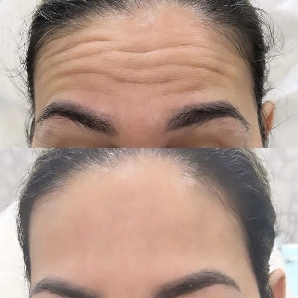 Botox
